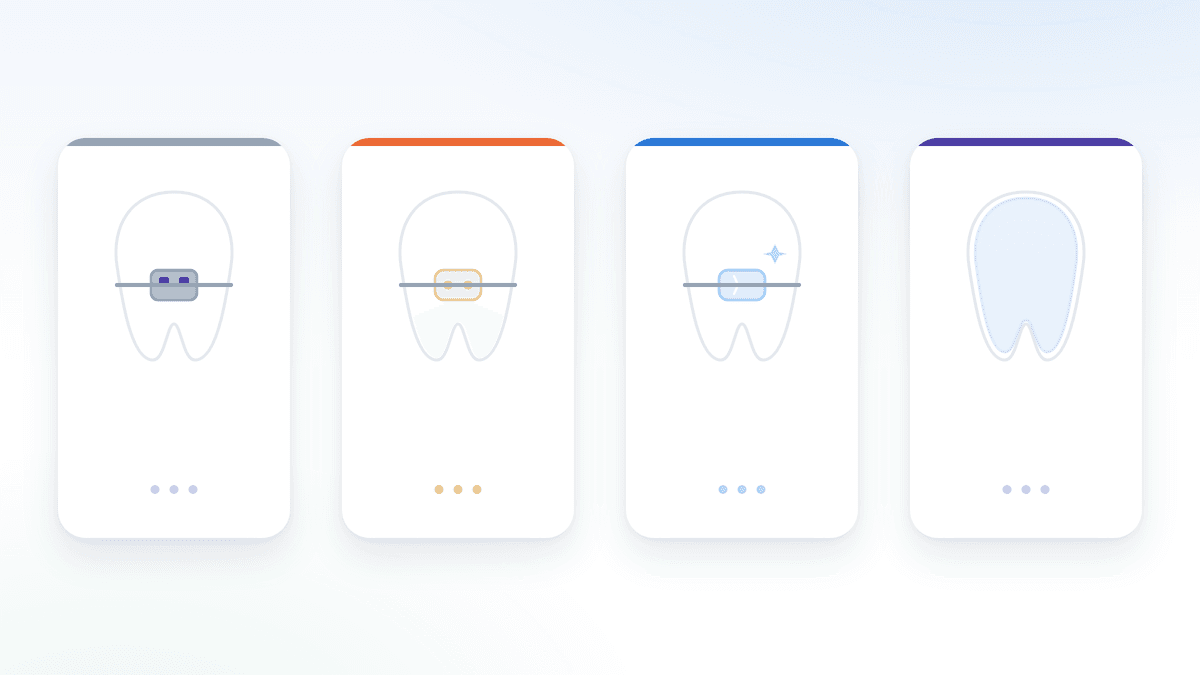 Các loại niềng răng phổ biến: mắc cài, sứ, pha lê hay Invisalign?